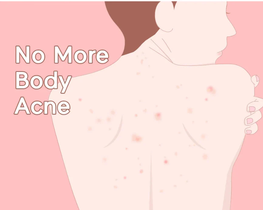 TIAM ANTI BLEMISH BODY LOTION - 200ML | تيام لوشن للجسم مضاد لحب الشباب و الأثار و التصبغات - 200 مل