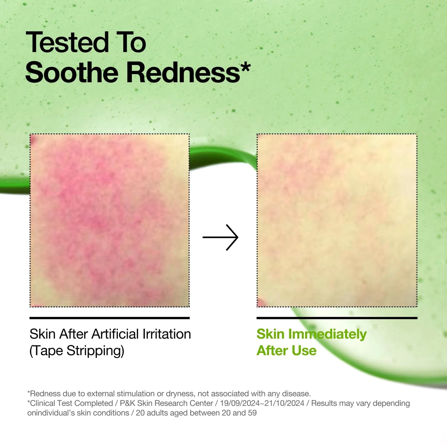 Anua Azelaic Acid 10 + Hyaluron Redness Soothing Serum – سيروم أزليك أسيد 10% مع الهيالورونيك لتهدئة الاحمرار