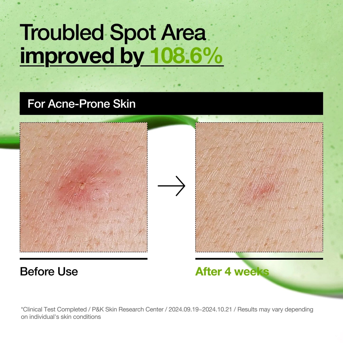 Anua Azelaic Acid 10 + Hyaluron Redness Soothing Serum – سيروم أزليك أسيد 10% مع الهيالورونيك لتهدئة الاحمرار