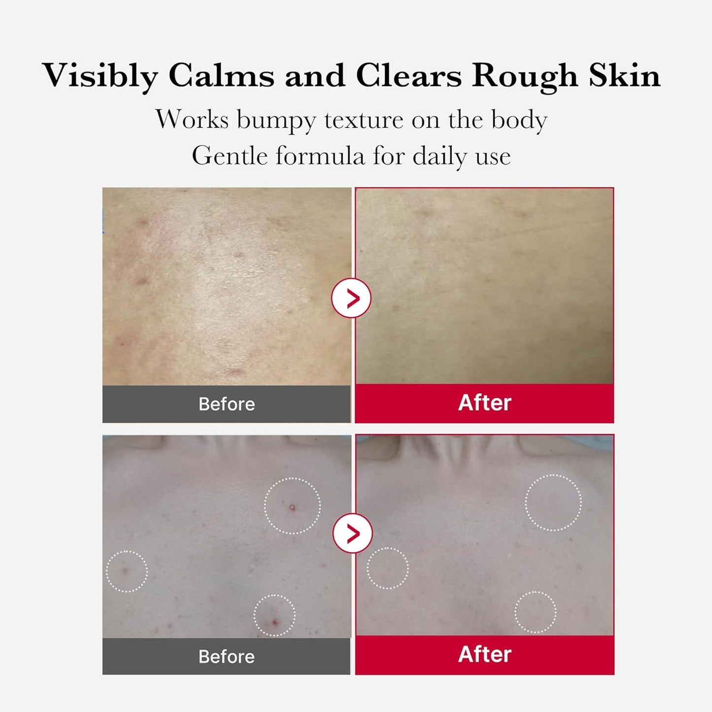 Medicube Red Acne Body Peeling Shot مقشر الجسم لتخلص من التصبغات وحب الشباب والبثور