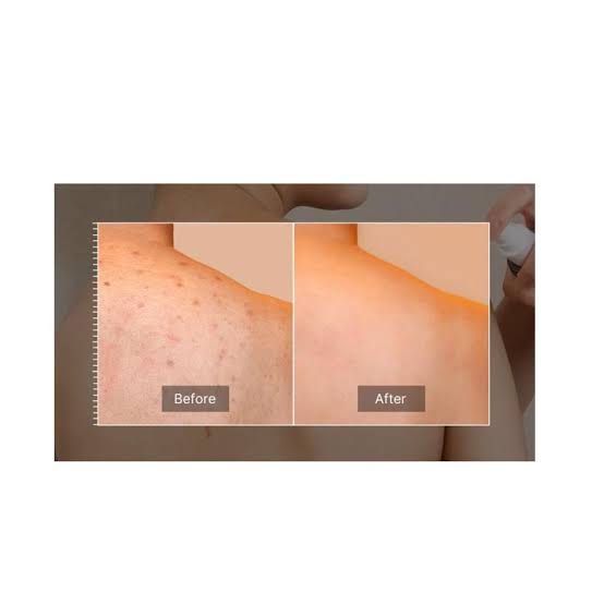 Medicube Red Acne Body Peeling Shot مقشر الجسم لتخلص من التصبغات وحب الشباب والبثور